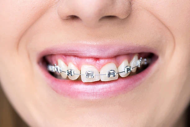 Aparelho dental