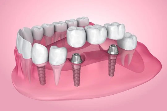 Implante de dente