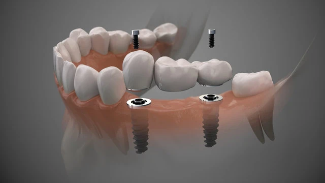 Prótese dentária fixa