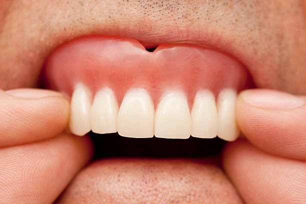 Prótese dentária removível